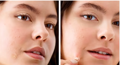 Parches para Acné - Acne Patch