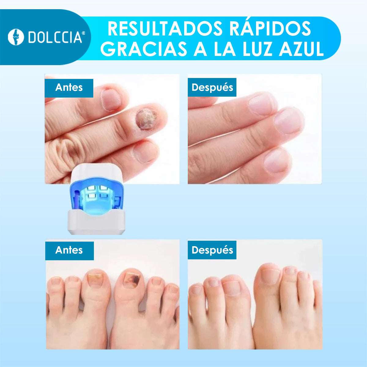 Laser para Uñas con Luz UV Dermolaser