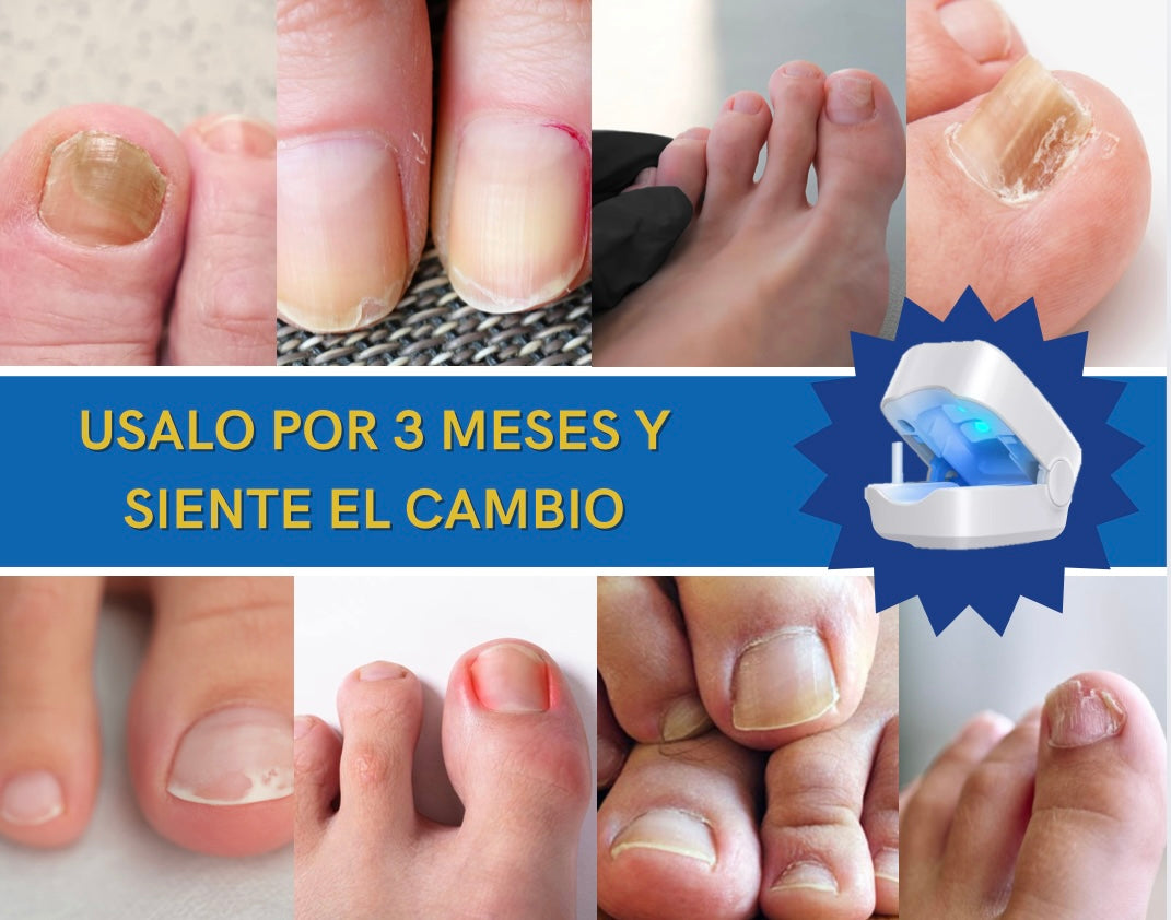 Laser para Uñas con Luz UV Dermolaser
